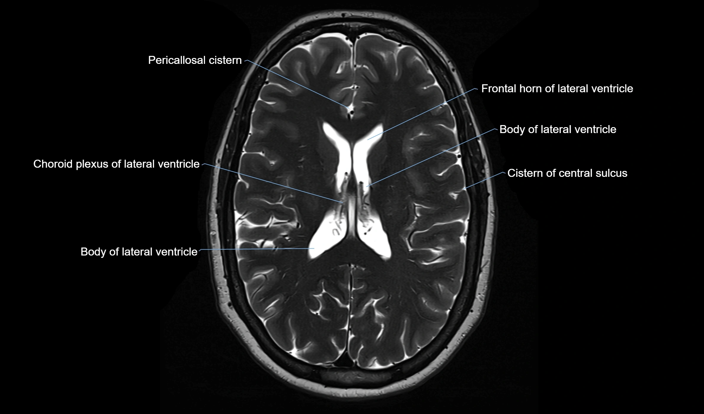 Brain cisterns  and ventricles  axial anatomy 3T MRI image-img-00001-00034.webp